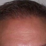 Hair Restoration & Reconstruction Before & After Patient #1024