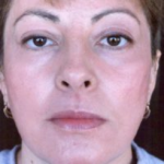 Non-Surgical Facelifts Before & After Patient #831