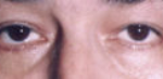 Lower Eyelids Before & After Patient #947