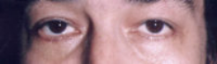Lower Eyelids Before & After Patient #947