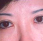 Asian Eyes Before & After Patient #980