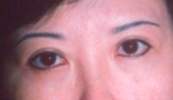 Asian Eyes Before & After Patient #980