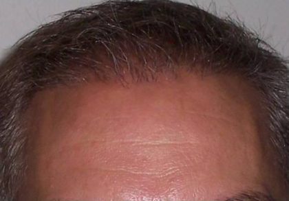 Hair Restoration & Reconstruction Before & After Patient #1024