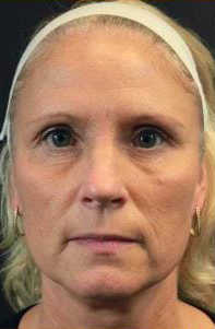 Facial Rejuvenation Before & After Patient #70