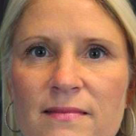 Facial Rejuvenation Before & After Patient #70
