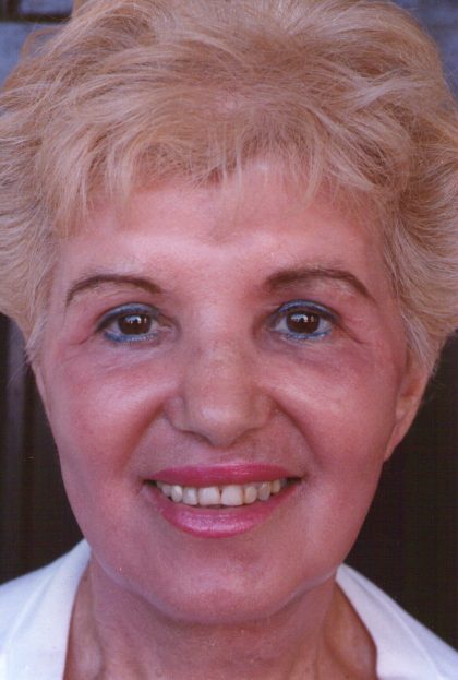 Facial Rejuvenation Before & After Patient #93