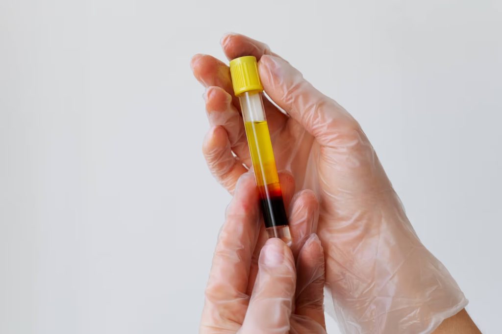 PRP Therapy