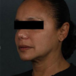 Silhouette InstaLift Before & After Patient #864