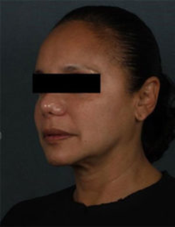 Silhouette InstaLift Before & After Patient #864