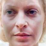 Non-Surgical Facelifts Before & After Patient #830