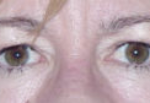 Lower Eyelids Before & After Patient #946