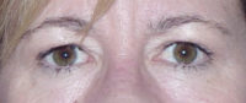 Lower Eyelids Before & After Patient #946