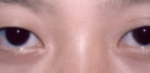 Asian Eyes Before & After Patient #979