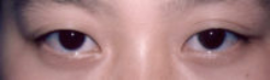 Asian Eyes Before & After Patient #979