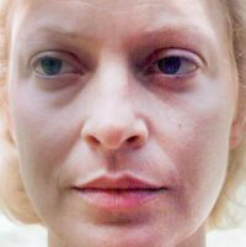 Non-Surgical Facelifts Before & After Patient #830
