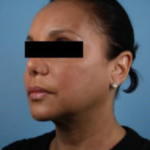 Silhouette InstaLift Before & After Patient #864