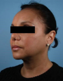 Silhouette InstaLift Before & After Patient #864