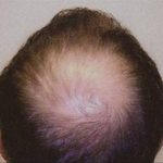 Hair Restoration & Reconstruction Before & After Patient #1023