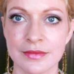 Non-Surgical Facelifts Before & After Patient #830