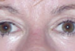 Lower Eyelids Before & After Patient #946
