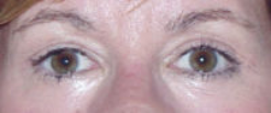 Lower Eyelids Before & After Patient #946