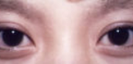 Asian Eyes Before & After Patient #979