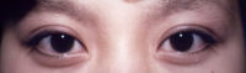 Asian Eyes Before & After Patient #979