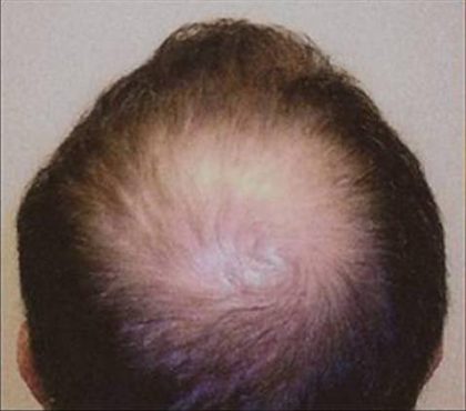 Hair Restoration & Reconstruction Before & After Patient #1023