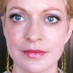 Non-Surgical Facelifts Before & After Patient #830