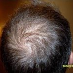 Hair Restoration & Reconstruction Before & After Patient #1023