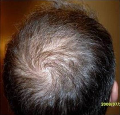 Hair Restoration & Reconstruction Before & After Patient #1023