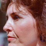 Non-Surgical Facelifts Before & After Patient #820