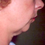 Facial Rejuvenation Before & After Patient #69