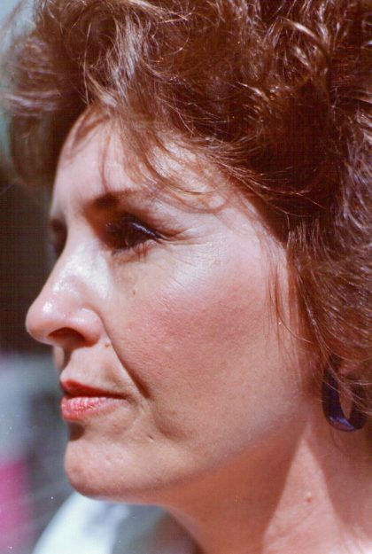 Non-Surgical Facelifts Before & After Patient #820