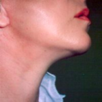 Facial Rejuvenation Before & After Patient #69