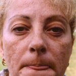Facial Rejuvenation Before & After Patient #92