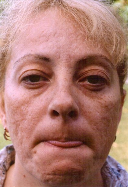 Facial Rejuvenation Before & After Patient #92