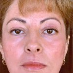 Facial Rejuvenation Before & After Patient #92