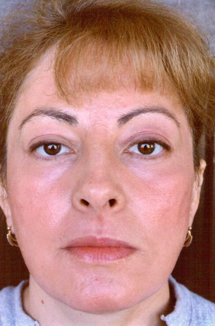 Facial Rejuvenation Before & After Patient #92