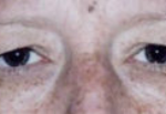 Lower Eyelids Before & After Patient #945