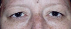 Lower Eyelids Before & After Patient #945
