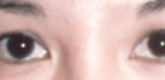 Asian Eyes Before & After Patient #978