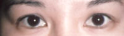 Asian Eyes Before & After Patient #978