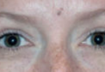 Lower Eyelids Before & After Patient #945