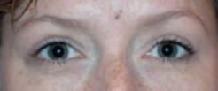 Lower Eyelids Before & After Patient #945
