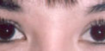 Asian Eyes Before & After Patient #978