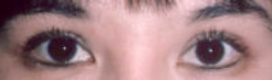Asian Eyes Before & After Patient #978