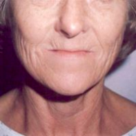 Facial Rejuvenation Before & After Patient #66