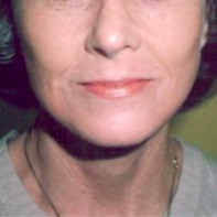 Facial Rejuvenation Before & After Patient #66