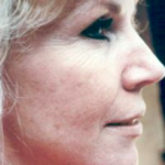 Non-Surgical Facelifts Before & After Patient #819
